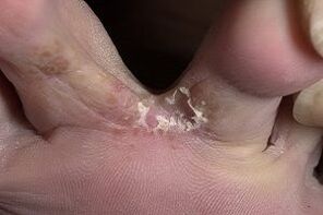 ādas sēnīte starp kāju pirkstiem