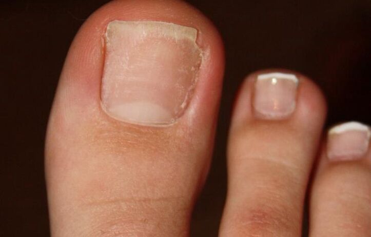 kāju pirkstu sēnītes simptomi