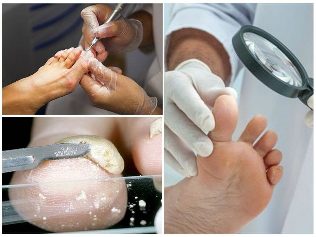 sēne kāju ādas diagnostika